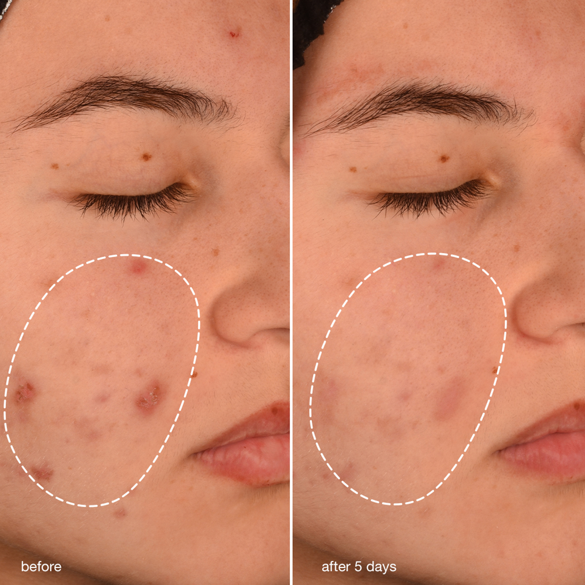 BreakoutBioticMoisturizer-Before_after