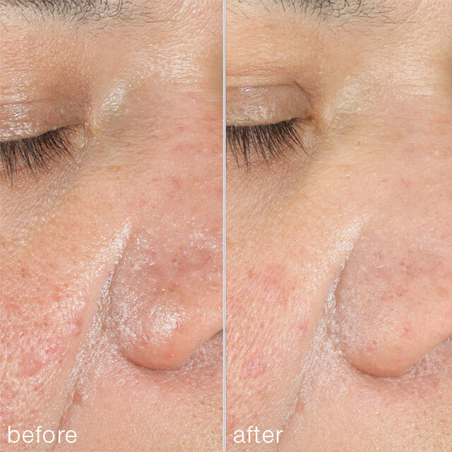powerbright dark spot peel b a