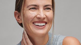 Hoe verminder je hyperpigmentatie? 