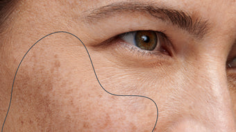 De beste ingrediënten voor het behandelen van pigmentvlekjes