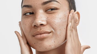 Exfoliëren van een vette huid