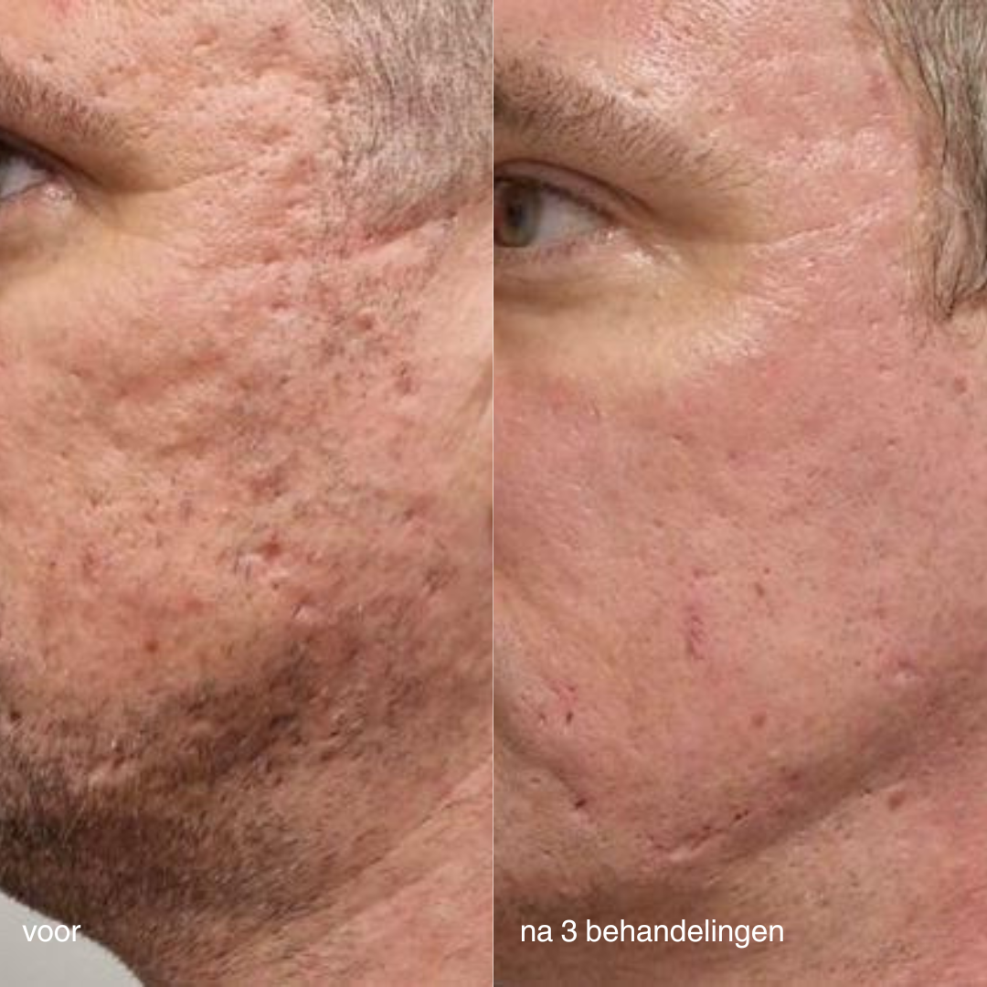 Dermalogica PRO microneedling before & after acnelittekens