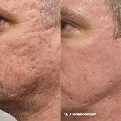 Dermalogica PRO microneedling before & after acnelittekens