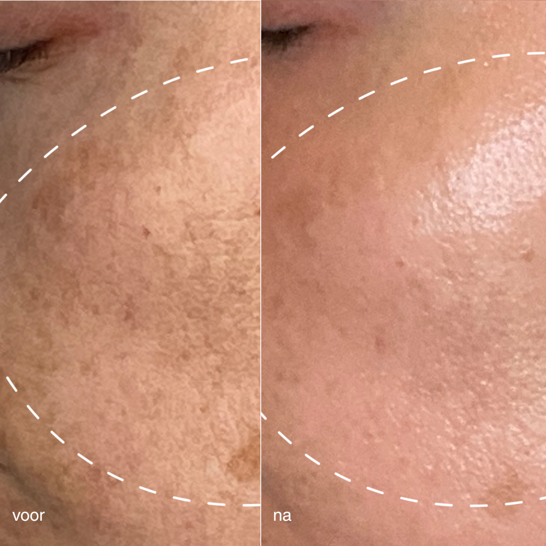 Dermalogica MelanoPro behandeling tegen hyperpigmentatie
