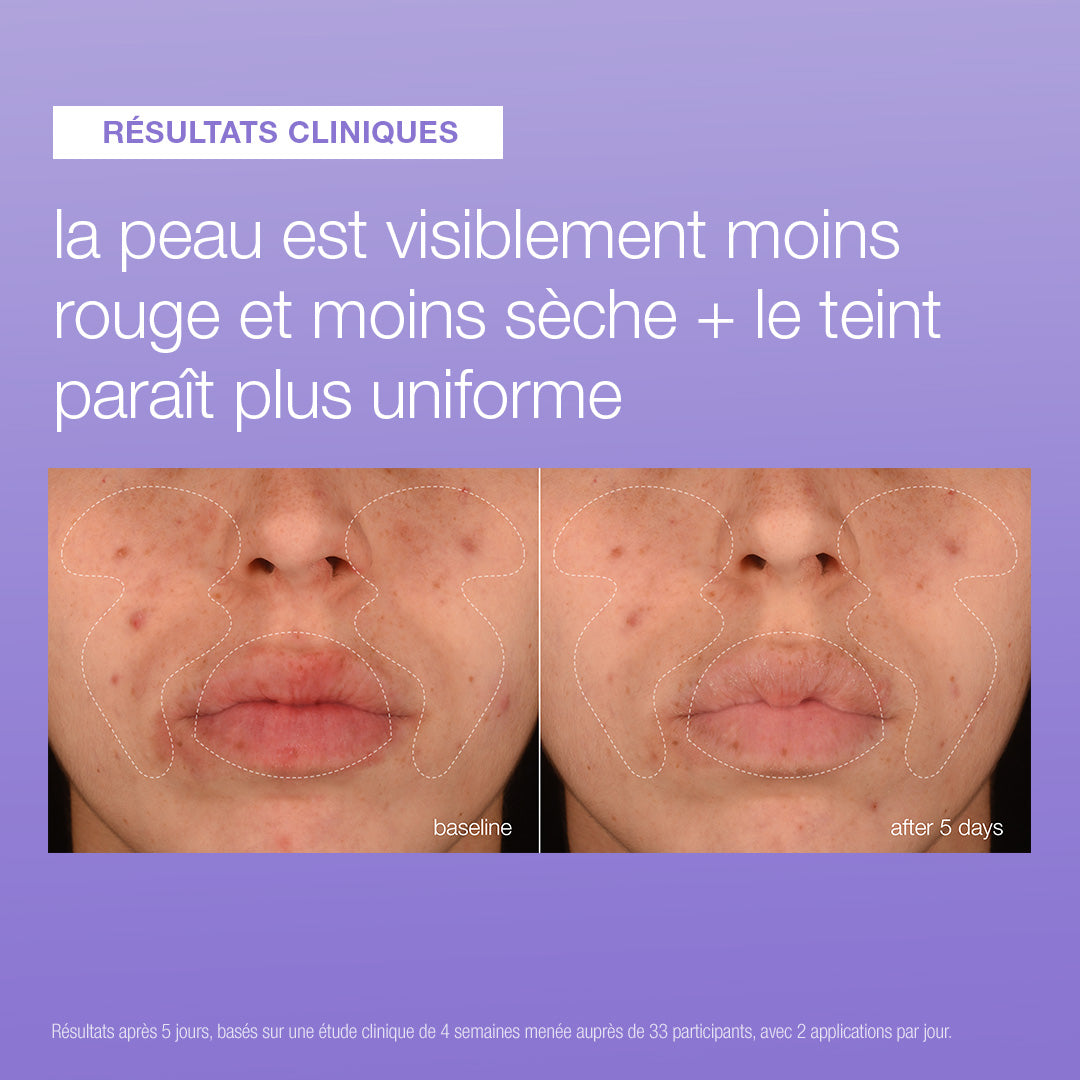 Avant et après 5 jours de Stabilizing Repair Serum : visage