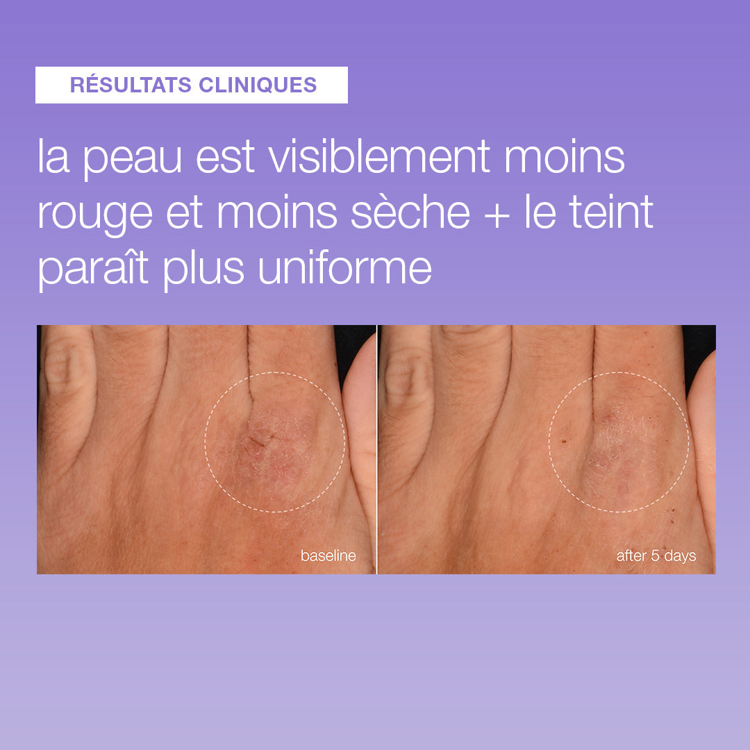 Avant et après 5 jours de Stabilizing Repair Serum : main