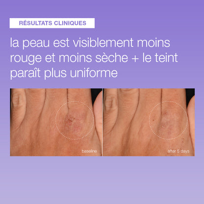 Avant et après 5 jours de Stabilizing Repair Serum : main