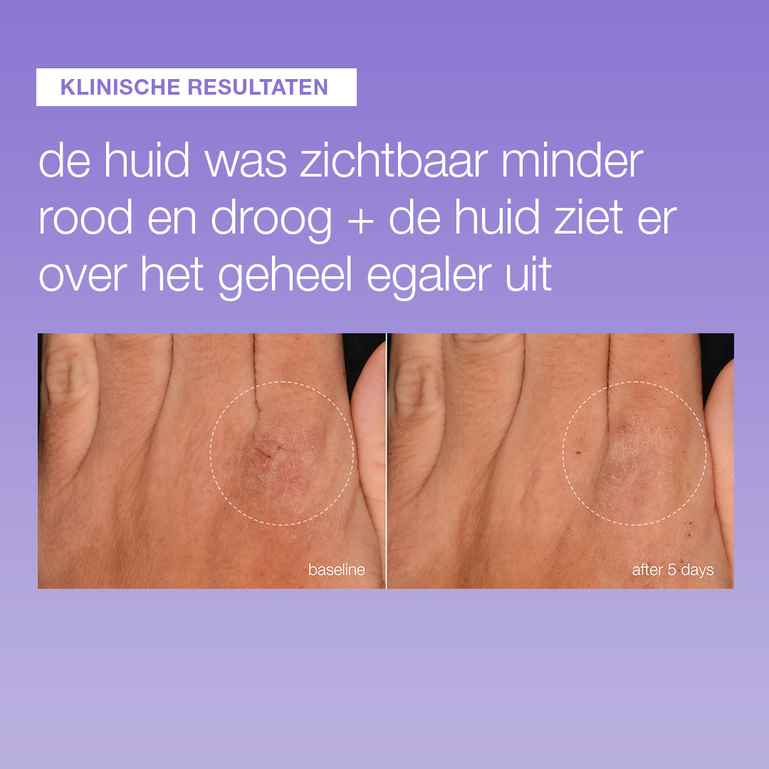 Voor en na 5 dagen Stabilizing Repair Serum: hand