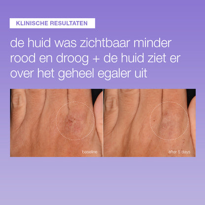 Voor en na 5 dagen Stabilizing Repair Serum: hand